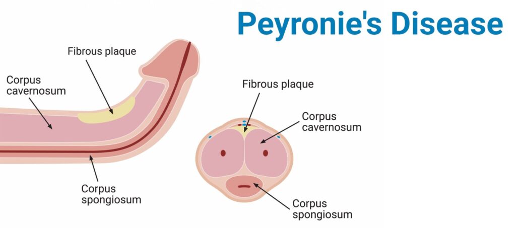 Νόσος Peyronie
